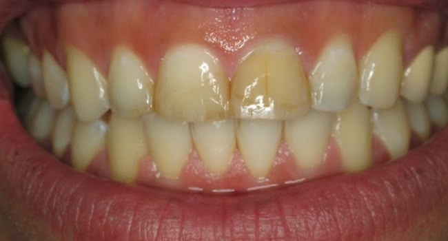A healthy smile showing stained teeth with dental issues.