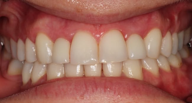 A smiling set of healthy, straight teeth with front implants