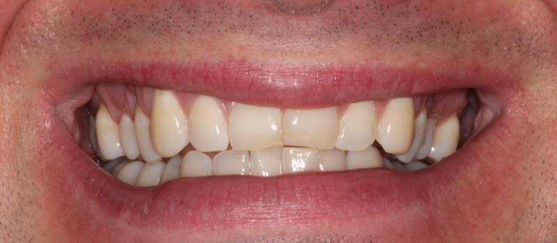 A smiling person showing uneven, stained teeth.