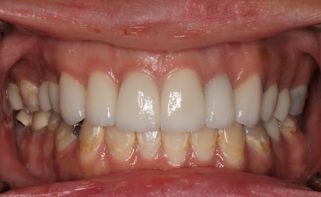 A healthy smile with well-aligned crowns