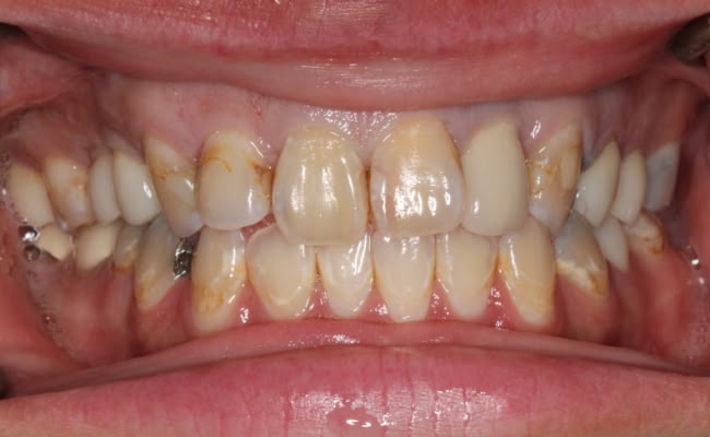 Close-up of misaligned and stained teeth with dental issues.