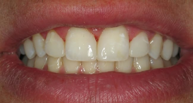 Close-up of a person's smile without gaps in the teeth