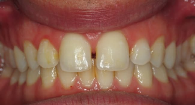 A smile showing misaligned and stained teeth