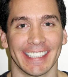 Bright smiling man without crowding and overbite
