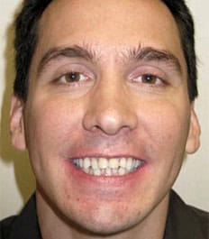 Bright smiling man with crowding and overbite