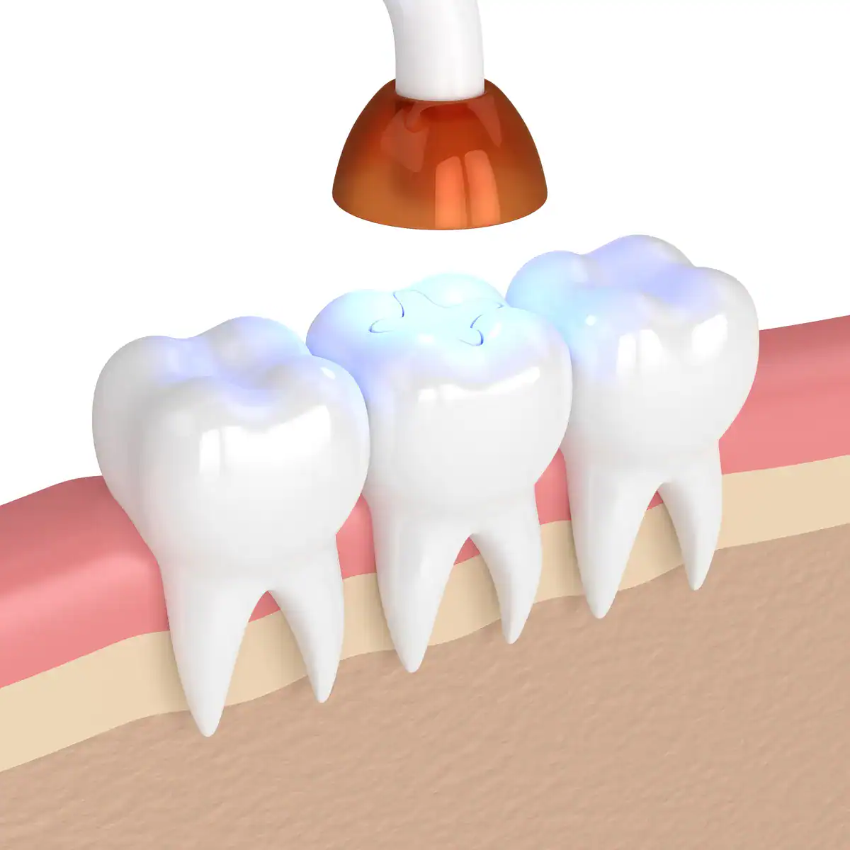 Modern tooth filling