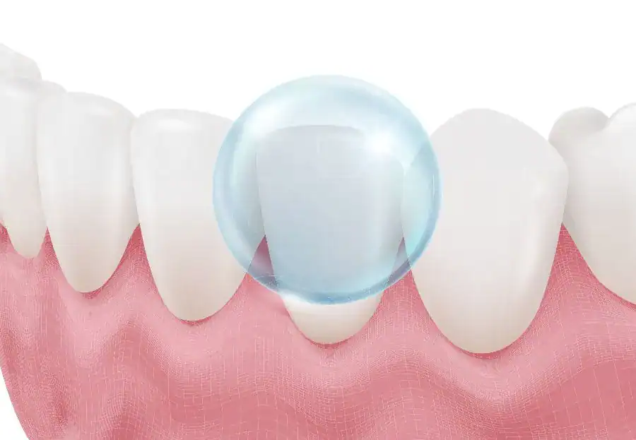 Fluoride bubble protecting teeth