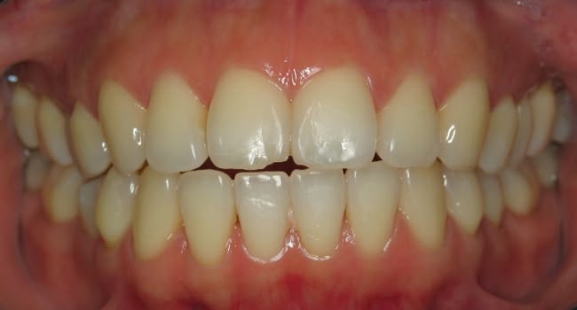 A healthy set of teeth and gums showing dental alignment and oral hygiene.