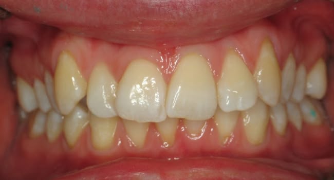 A set of teeth with misalignment and visible plaque buildup.