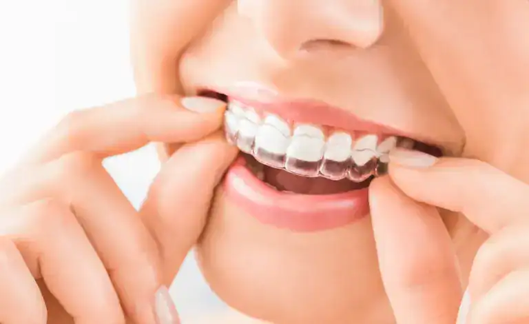 Clear dental aligners being placed on teeth for orthodontic treatment