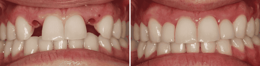 Dental patient before and after teeth whitening at Rincon Dental.
