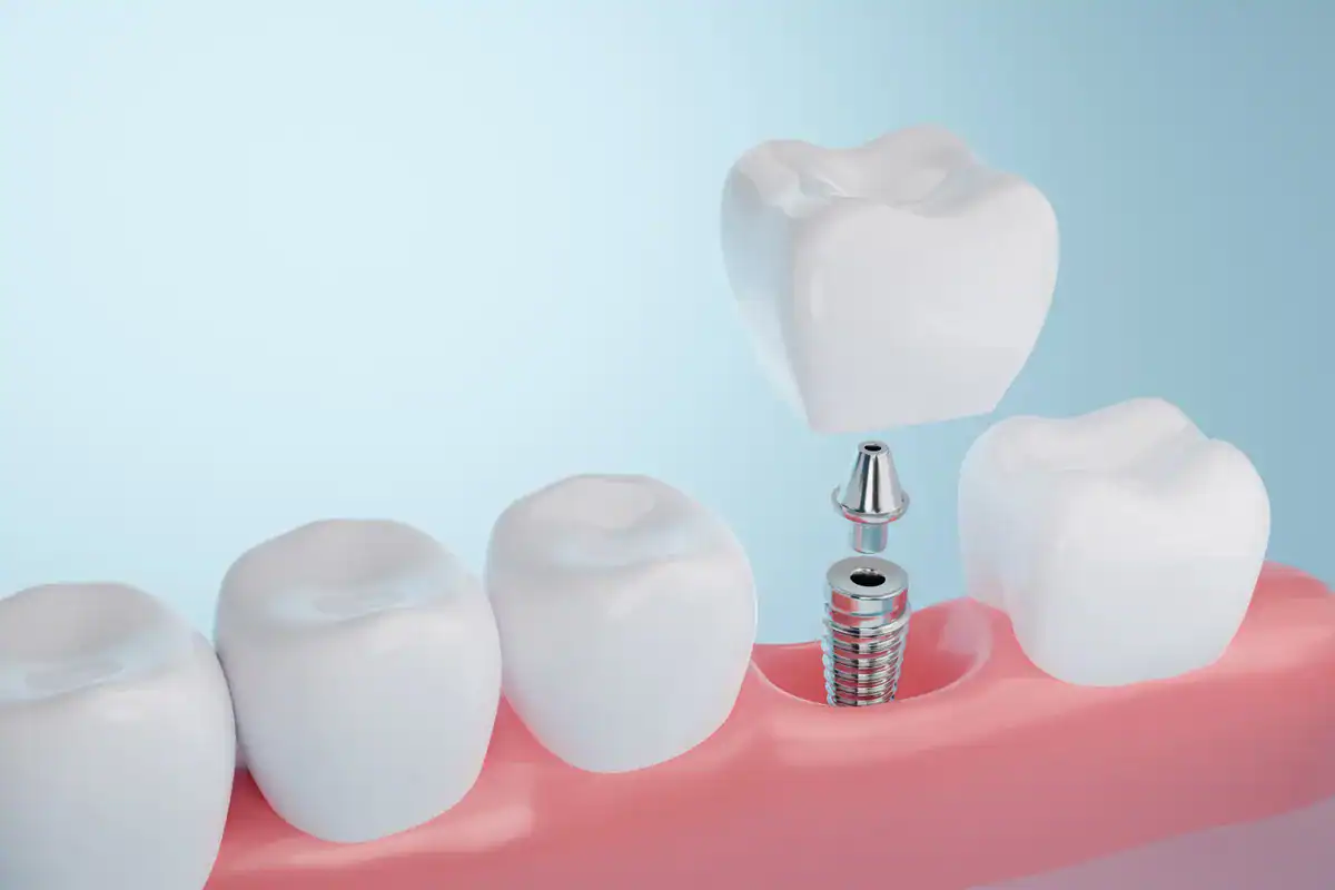 A dental implant with a crown being placed on a patient's gum.